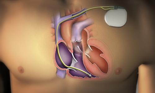 καρδιολογος-καρατζας-αθηνα